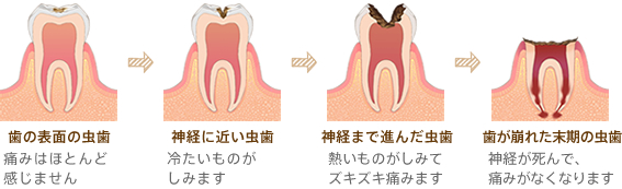 虫歯の進行